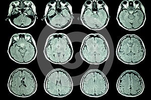 MRI scan of patient brain photo