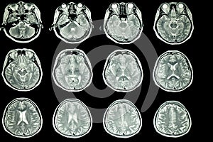 MRI scan of patient brain photo