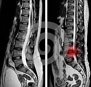 MRI scan sagittal view Lumbosacral spine has straightening lumbar alignment, L5-S1 photo