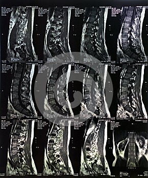 MRI Scan Spine photo