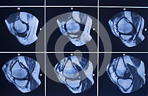 MRI scan test results knee meniscus injury