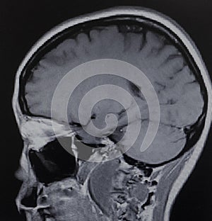 Mri schwannoma brain acoustic neuroma exam