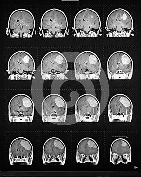 Mri sequence of brain showing tumor