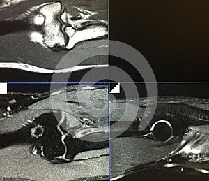 Mri severe tearing biceps tendon