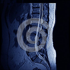 MRI Spine