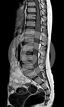 MRI spine showing mass at distal cord and conus medullaris, with tumor seedings at lower spinal canal. The mass appear hypersignal