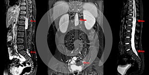 MRI spine showing mass at distal cord and conus medullaris, with tumor seedings at lower spinal canal. The mass appear hypersignal