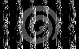 MRI spine showing mass at distal cord and conus medullaris, with tumor seedings at lower spinal canal. The mass appear hypersignal