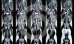 MRI spine showing mass at distal cord and conus medullaris, with tumor seedings at lower spinal canal. The mass appear hypersignal