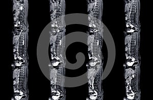 MRI spine showing mass at distal cord and conus medullaris, with tumor seedings at lower spinal canal. The mass appear hypersignal