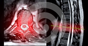 MRI T-L spine or Thoracosacral spine Axial and sagittal T2 technique with reference line  for diagnosis spinal cord compression