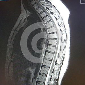 Mri of thoracic spine pathology