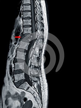 MRI OF THORACOLUMBAR SPINE Moderate to severe compression fracture of L1 vertebra photo