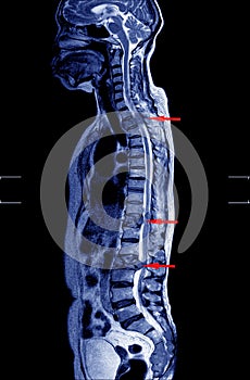 MRI OF THORACOLUMBAR SPINE There is decreased lumbosacral lordosis without spondylolisthesis photo