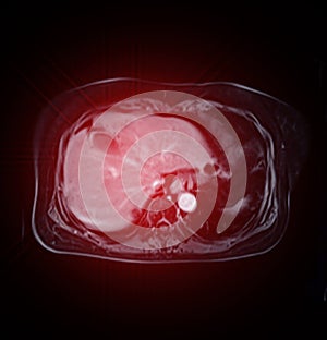 MRI of the upper abdomen coronal view is a non-invasive imaging technique providing detailed visuals of organs like the liver, photo