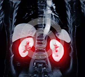 MRI of the upper abdomen coronal view is a non-invasive imaging technique providing detailed visuals of organs like the liver, photo
