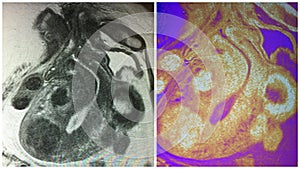 Mri uterine endometrial polyps menopausal collage photo