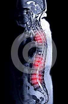 MRI whole spine screening sagittal T2 .