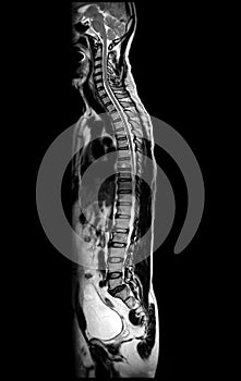 MRI of whole spine  T2W sagittal  plane
