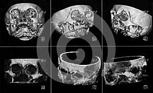 MRIs