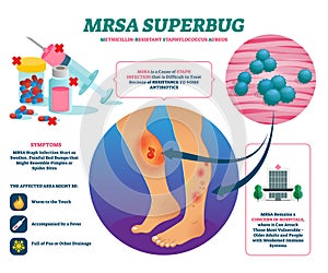 MRSA super bug vector illustration. Labeled staph infection explain scheme.