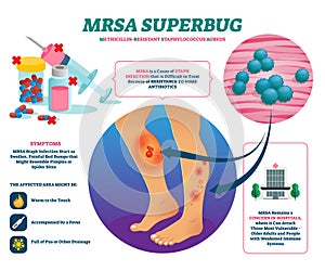 MRSA super bug vector illustration. Labeled staph infection explain scheme. photo