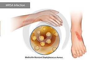 MRSA Superbug Infection. Methicillin Resistant Staphylococcus Aureus. Rashes on the arms and legs caused by