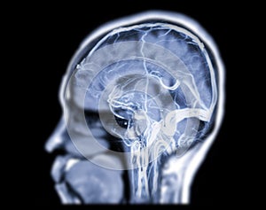 MRV Brain or magnetic resonance venography of The Brain for abnormalities in venous drainage of the brain sagittal view