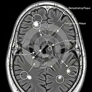 MS MRI: visible brain lesions