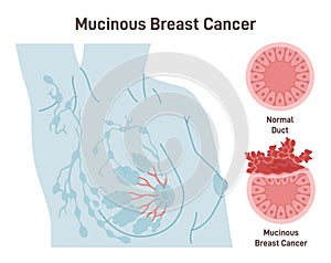 Mucinous breast cancer. Detailed breast medical anatomy with lactiferous