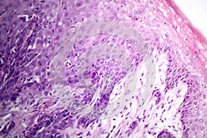 Mucinous carcinoma in the stomach, light micrograph