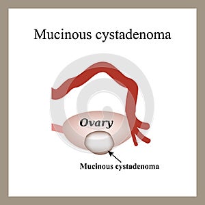 Mucinous cyst on the ovary. Cystadenoma. Ovary.