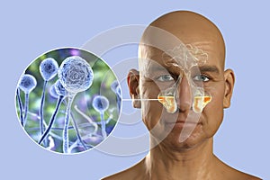 Mucor fungi as a cause of sinusitis, 3D illustration photo