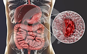 Mucosa of stomach with peptic ulcer