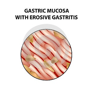 Mucous stomach with erosive gastritis. Infographics. Vector illustration on isolated background