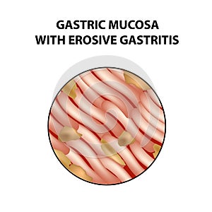 Mucous stomach with erosive gastritis. Infographics. Vector illustration on isolated background photo