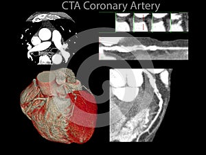 Muiti view of CTA Coronary artery 2D and 3D rendering image. photo