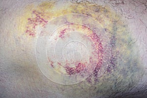 Multi-colored bruise on body. Close-up is wounded leg with bruise and abrasion. Injured skin. Household injuries, harm to health
