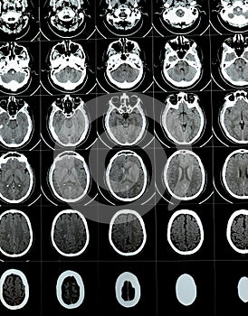Multi slice CT scan of the brain showing Large brain stem and right centrum semiovale hematoma, normal posterior fossa structures photo