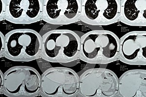 Multi slice CT scan of the chest showing normal study, normal appearance of the lungs, parenchyma, pulmonary vasculature, photo