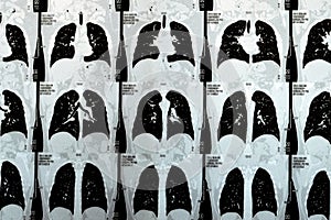 Multi slice CT scan of the chest showing normal study, normal appearance of the lungs, parenchyma, pulmonary vasculature, photo