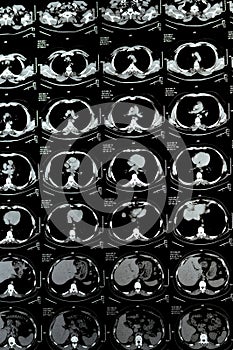 Multi slice CT scan of the chest showing normal study, normal appearance of the lungs, parenchyma, pulmonary vasculature, photo