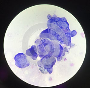 Multinucleated cell in Tzanck test