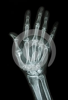 Multiple fracture at index,little finger,metacarpal bone photo