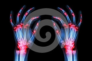 Multiple joint arthritis both adult hands ( Gout , Rheumatoid ) on black background photo