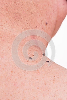 Multiple mole on neck and shoulder of Asian male