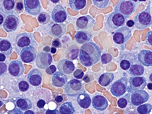Multiple myeloma in the bone marrow.