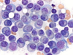 Multiple myeloma in the bone marrow.