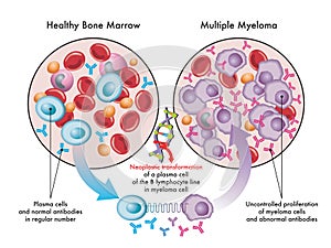 Multiple Myeloma medical illustration
