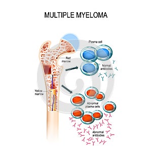 Multiple myeloma. plasma cell myeloma